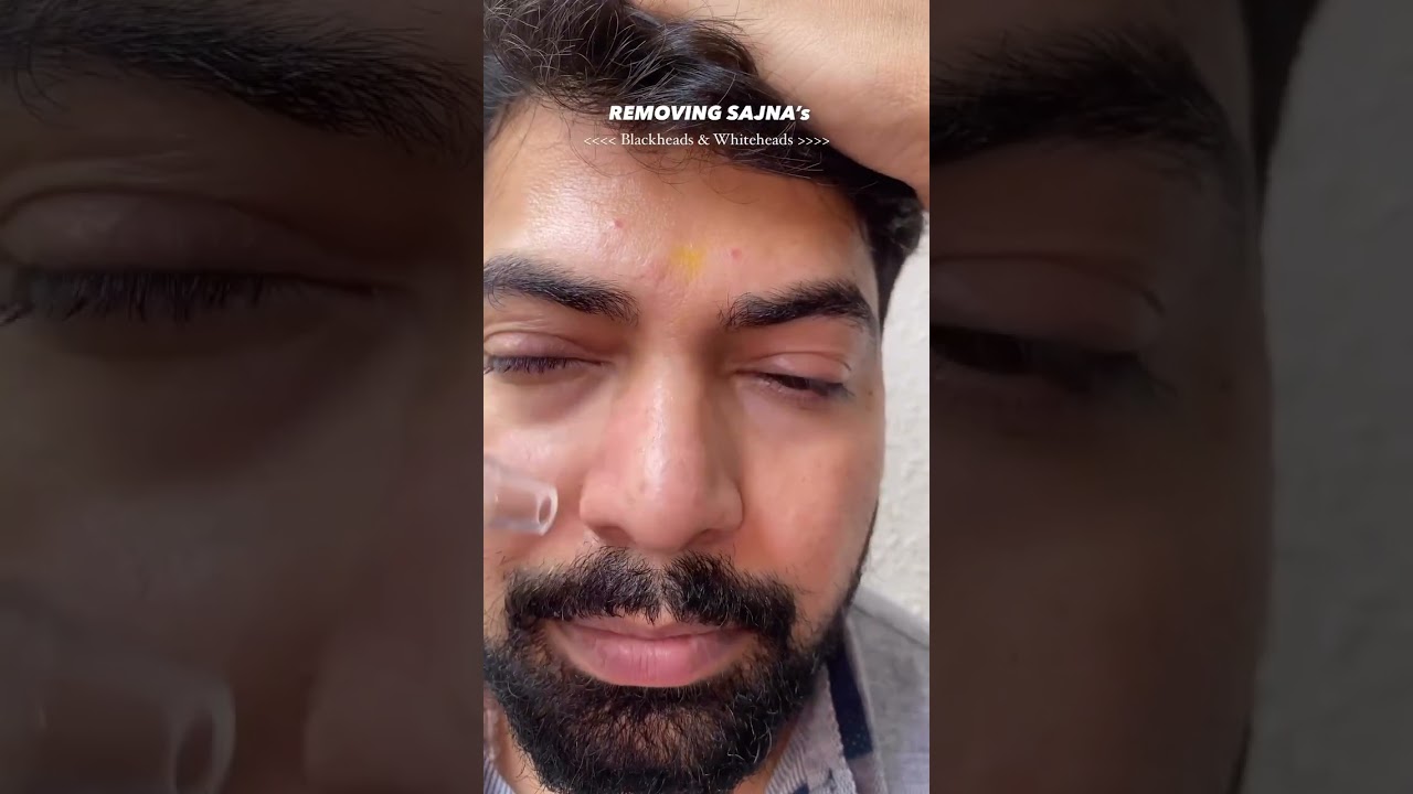 Blackhead Remover | Winston Blackhead Remover