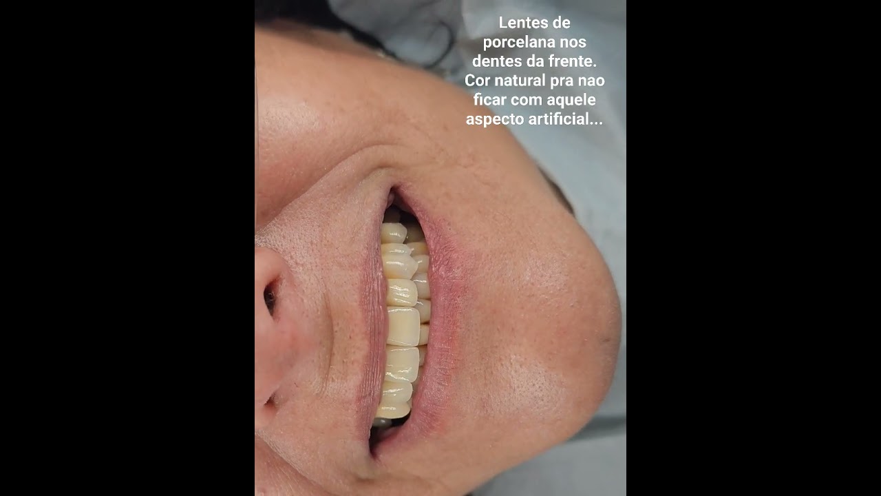 Lentes de porcelana nos dentes da frente com bastante naturalidade. Cor bem natural.