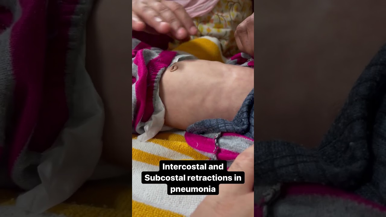 Respiratory Distress Syndrome #fyp #fypage #nicu #picu #hospital #rds #baby #care #medicalshorts #fy