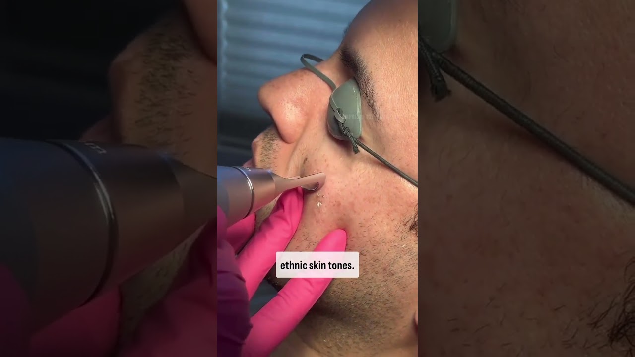 Pico Laser for Brown Spots #dermatology #picolaser