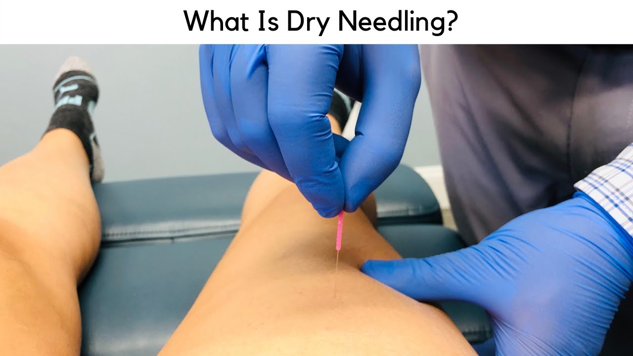 What Is Dry Needling?