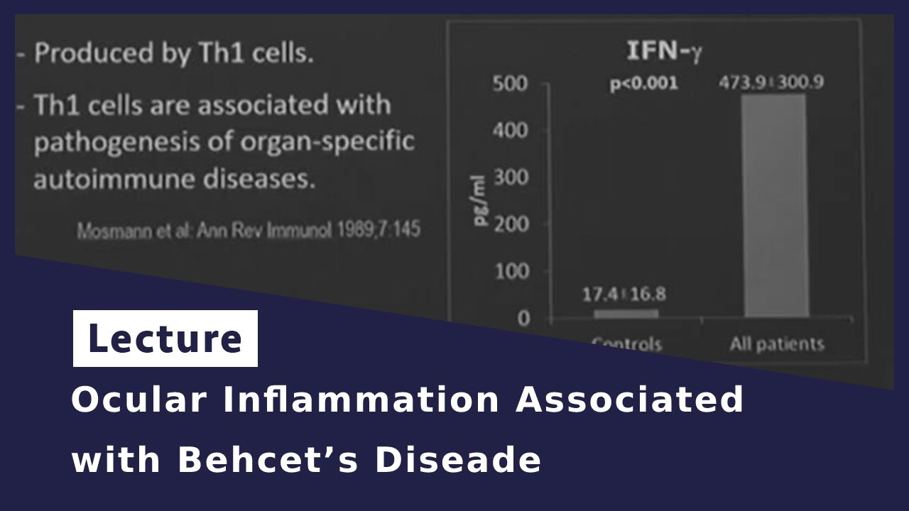 Ocular Inflammation Associated with Behcet’s Diseade