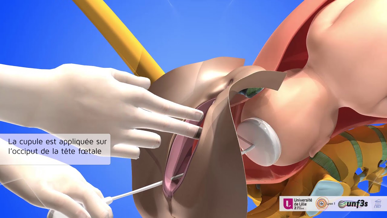 L'accouchement par ventouse