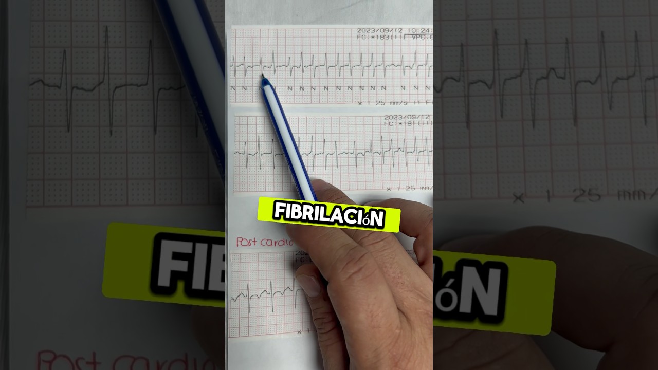 Caso real de Fibrilaci&oacute;n auricular r&aacute;pida 🫀⚡️ #emergency