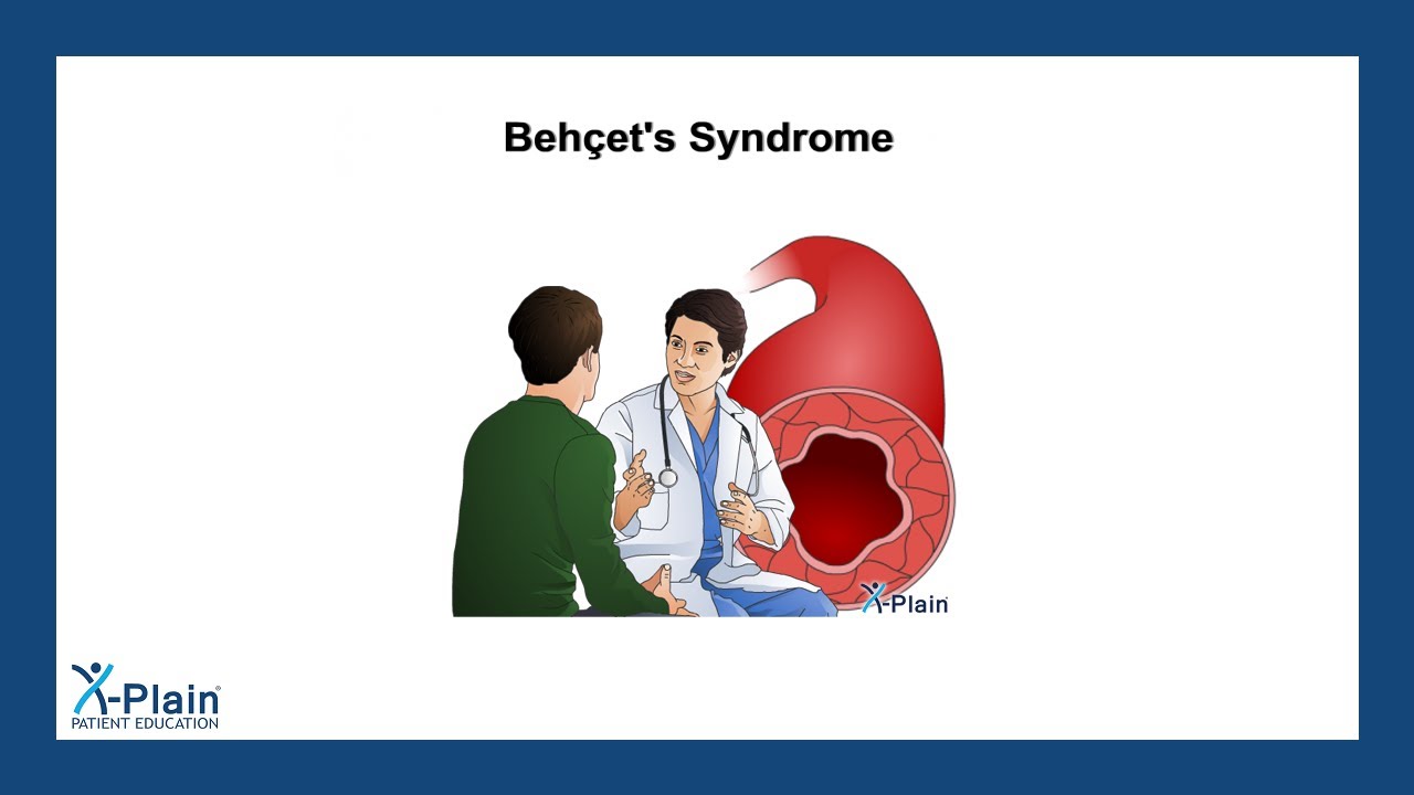 Behcet's Syndrome