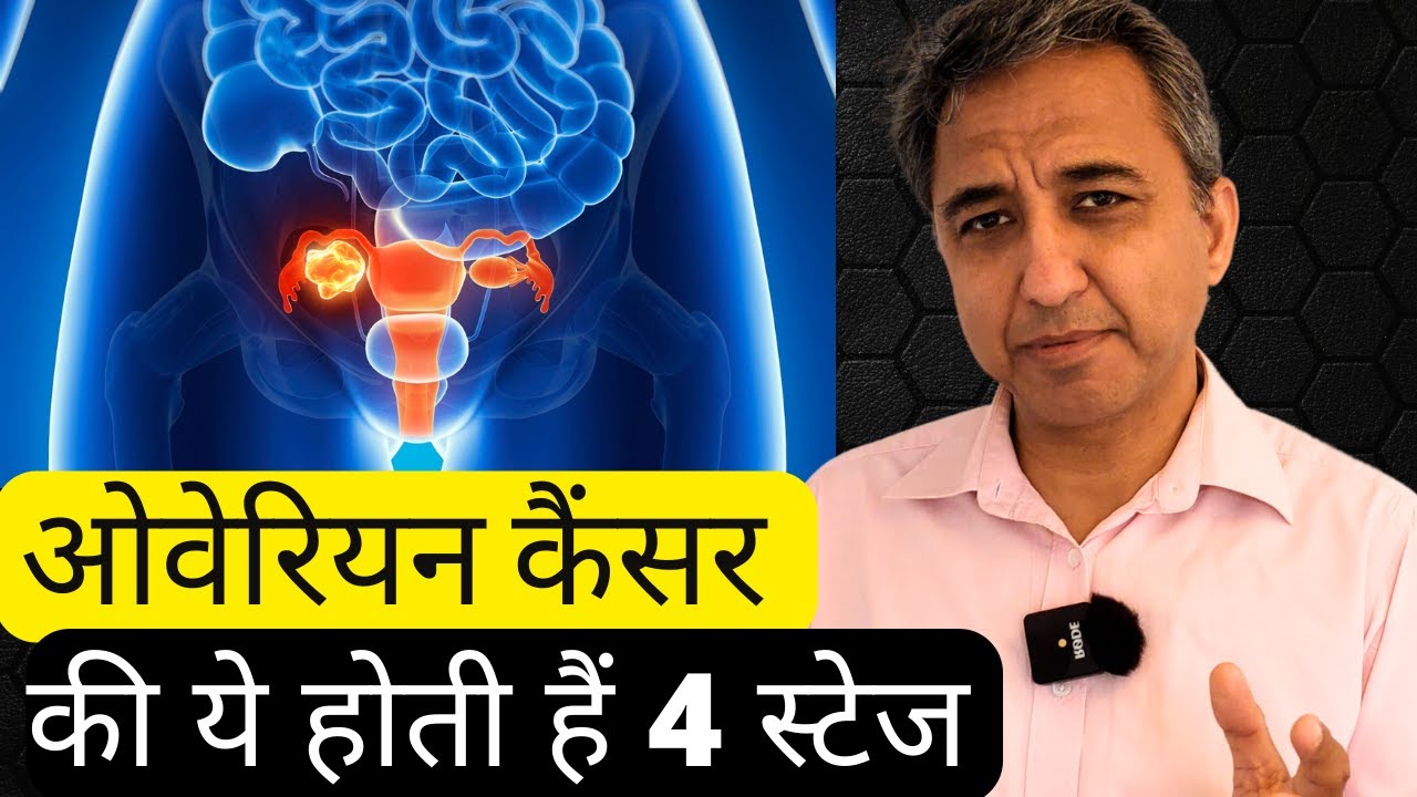 The 4 Stages of Ovarian Cancer Explained in Hindi with 3D