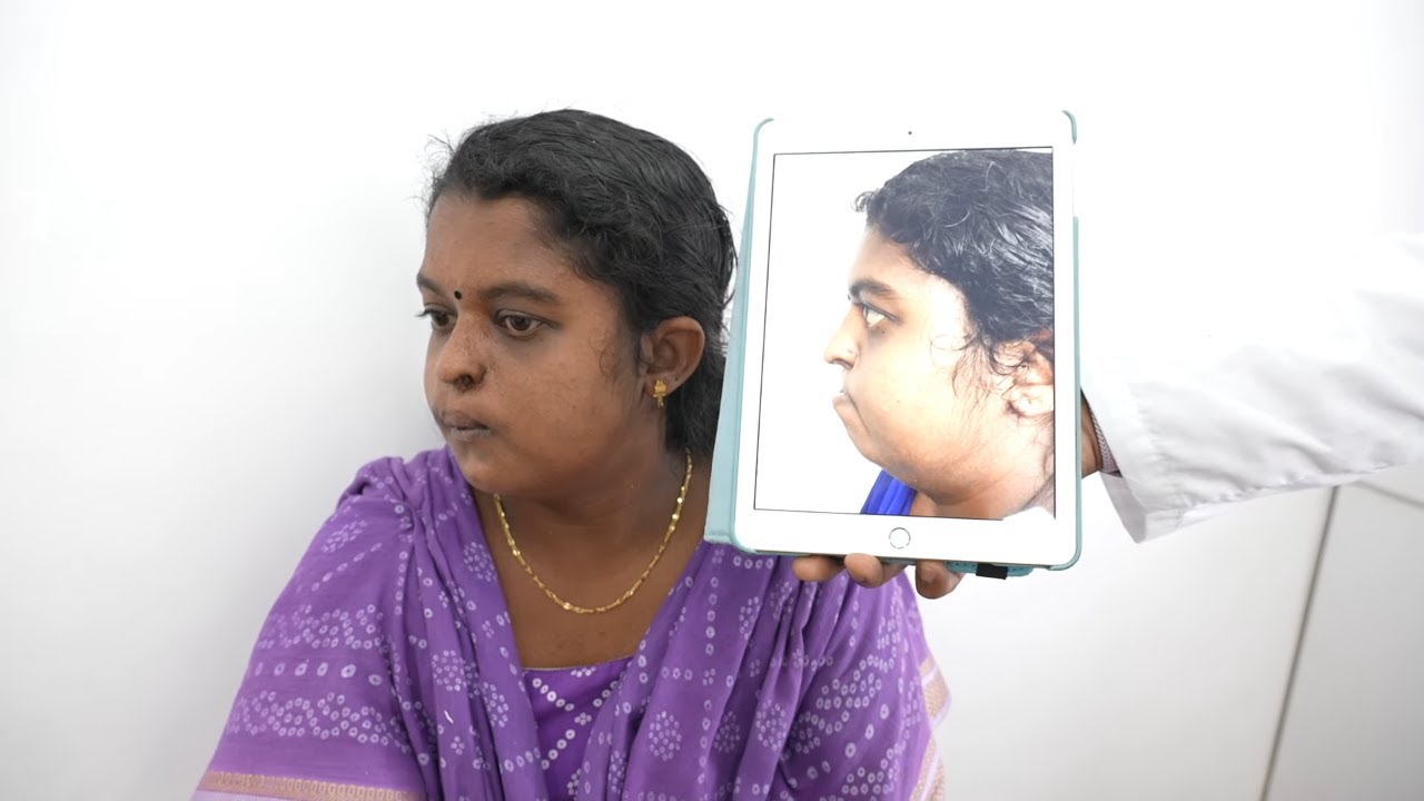 Revision Jaw Surgery for a Cleft Patient - Dr. Sunil Richardson