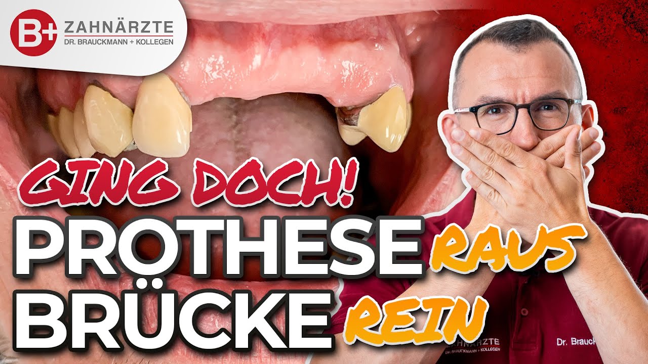 Nie mehr Zahnprothese kleben! Patient tauscht lockere Prothese gegen feste Brücke im Oberkiefer!