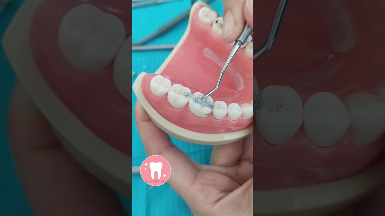 طريقة عمل حشوة أملغم class 1 amalgam restoration