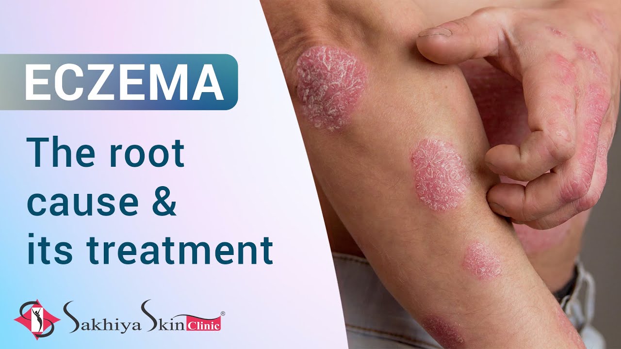 Eczema | Root Causes & Treatment | How to get rid of Eczema | Dr.Jagdish Sakhiya ( In Hindi )