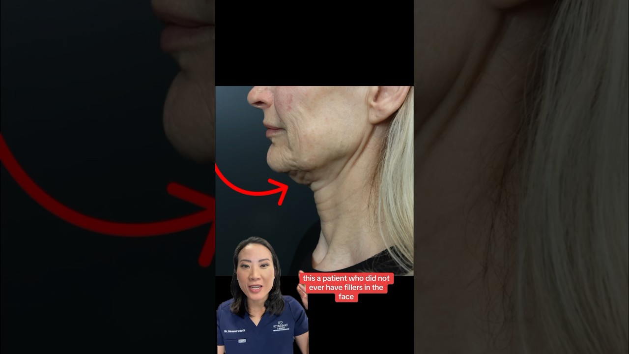 🕰️ FEELING YOUNGER THAN EVER (Before After Results) #facelift