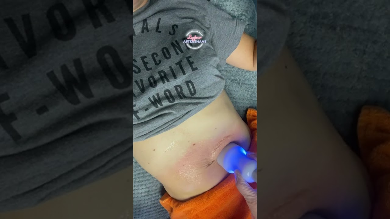 Fat Reduction with Thermal Shock