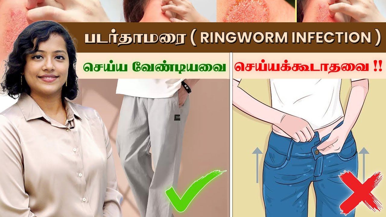 🦠 படர்தாமரை (Ringworm Infection) – செய்ய வேண்டியவை ✅ மற்றும் செய்யக்கூடாதவை ❌DERMIIZ SKIN AND HAIR