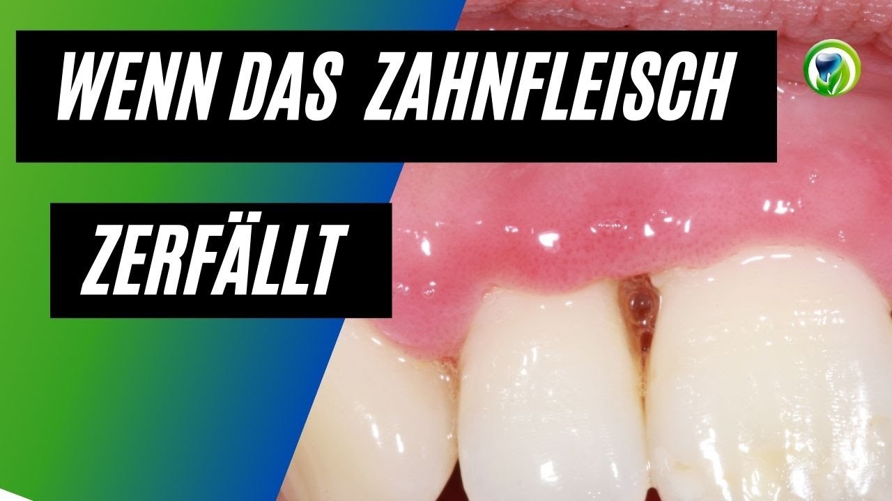 Wenn das Zahnfleisch zerfällt - eine drohende Gefahr - NUG/ANUG, NUP/ANUG - Zahnfleischerkrankung