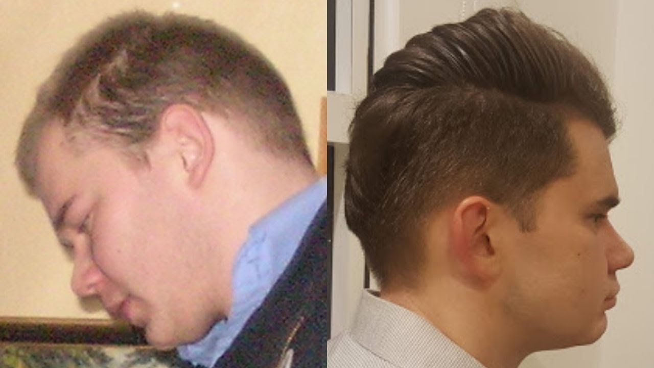 Diffused Alopecia And Dupa Hair Loss I Regrow It Back