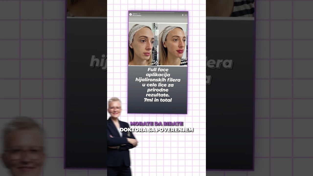 Hijaluronski fileri u temporalnoj regiji