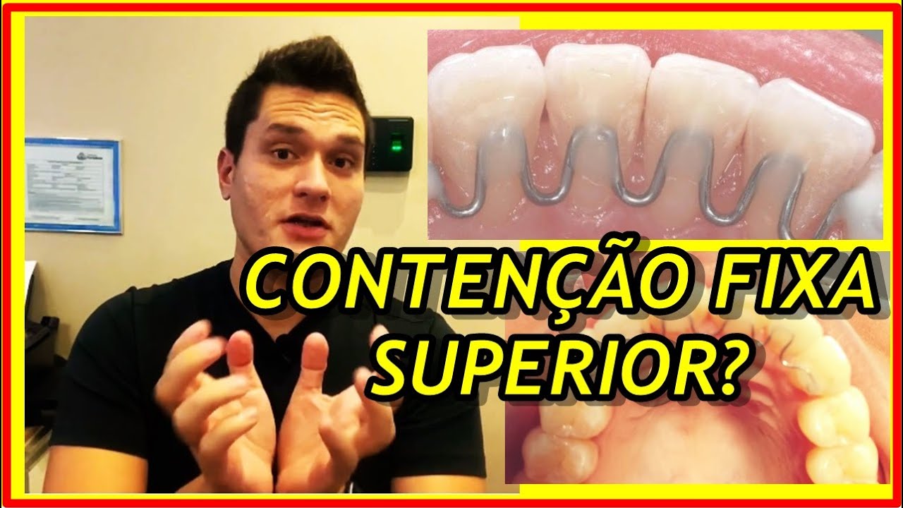 Contenção Fixa Superior | Conheça a CONTENÇÃO ORTODÔNTICA INVISÍVEL!