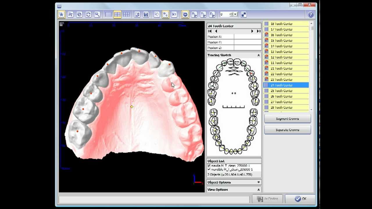 Virtual Tooth / Model Segmentation in OnyxCeph³