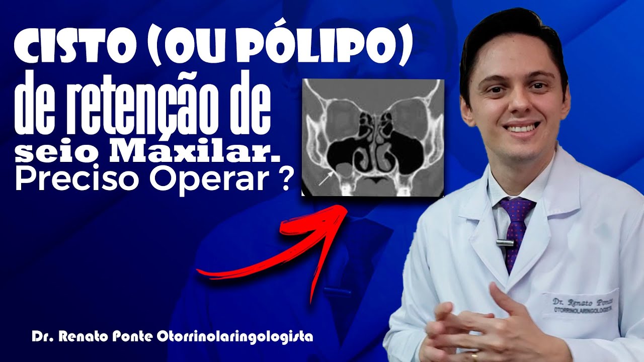 Precisa OPERAR ? Cisto ou Pólipo de Retenção no Seio Maxilar.  Dr.Renato Ponte Otorrino em Fortaleza