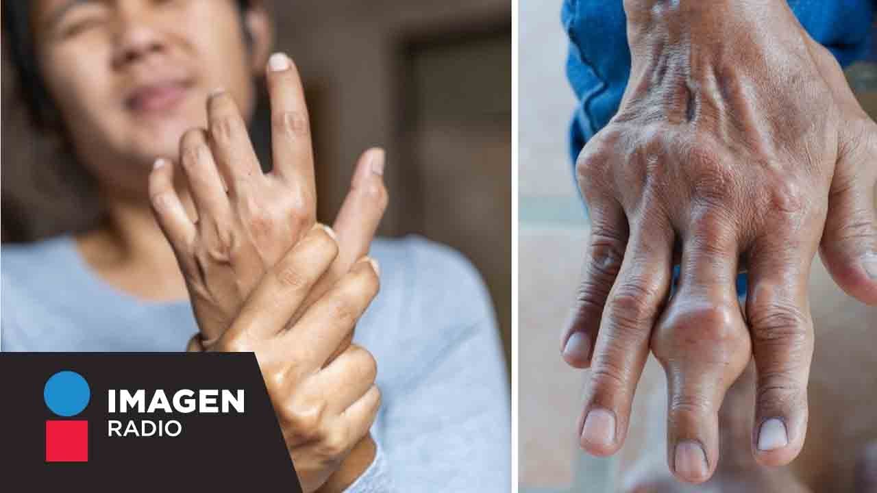 ¿Qué es y qué causa la artritis reumatoide? | Bien y Saludable