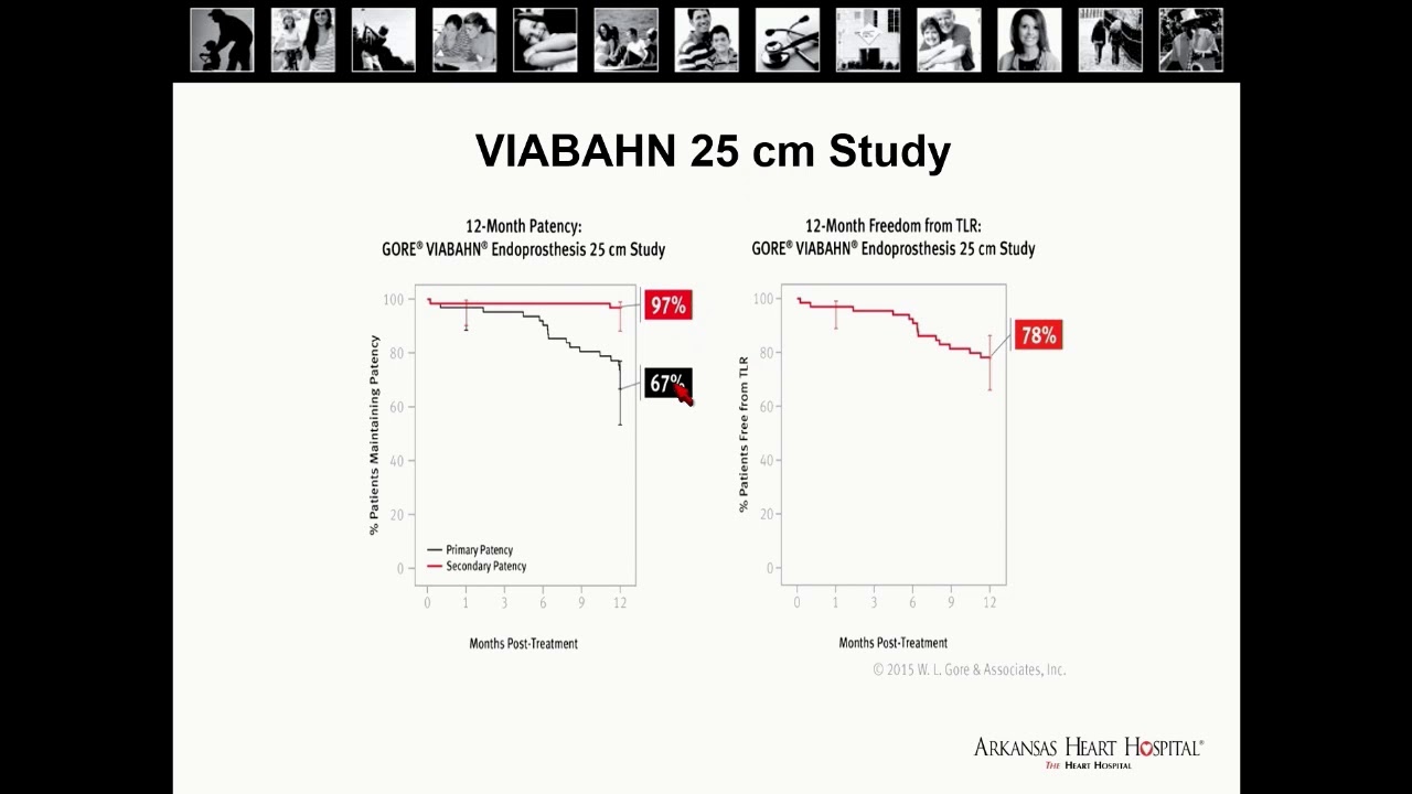 Viabahn, When and Why? - Ian Cawich, MD
