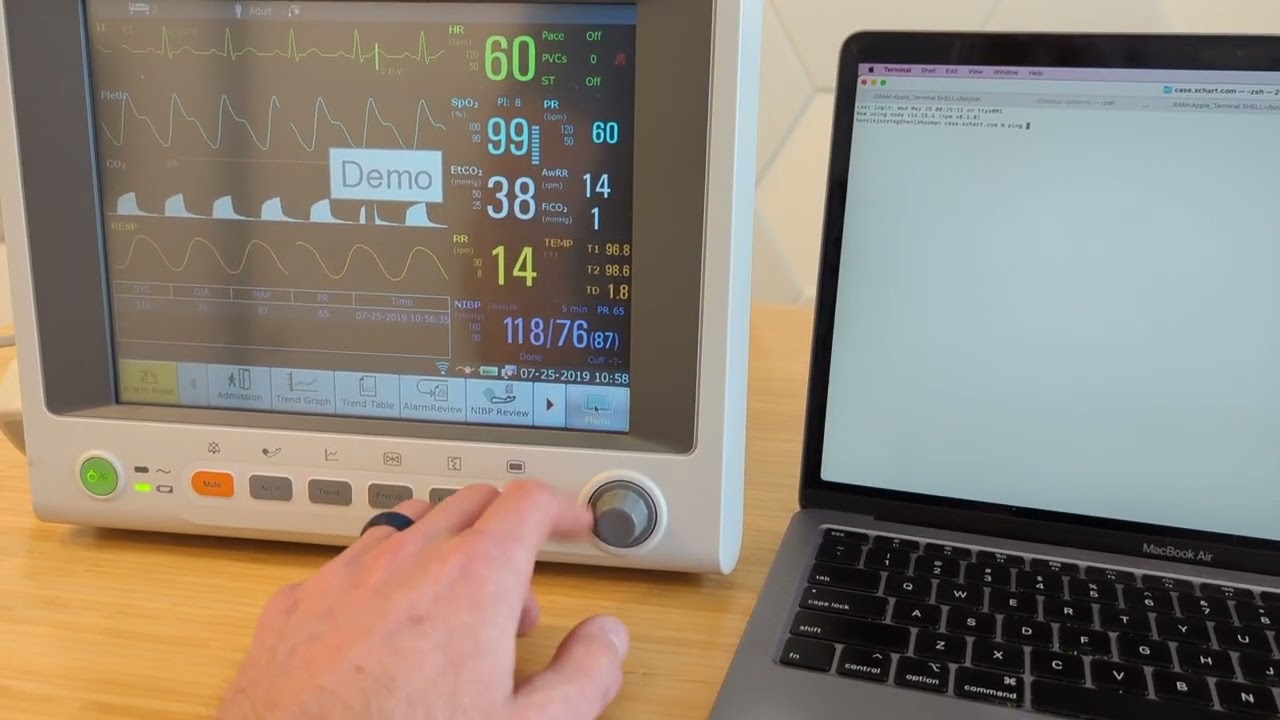 Connecting Edan iM60 To Xchart.com for automatic vitals charting