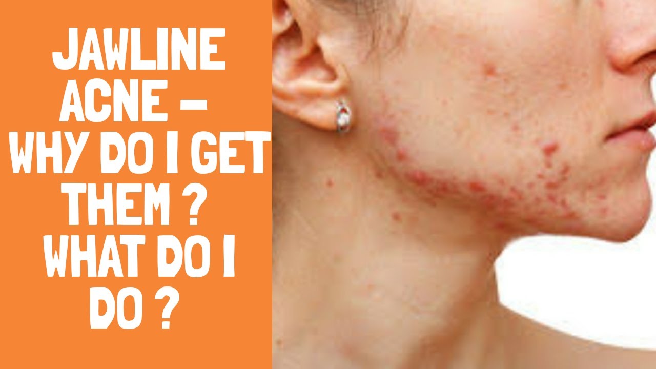 Jawline Acne - Why do I get Acne on my Jawline & how do I manage them ?