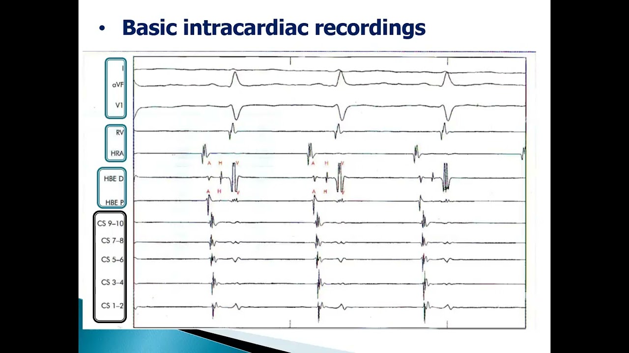 Tracing revision ecg 2023 dr sherif