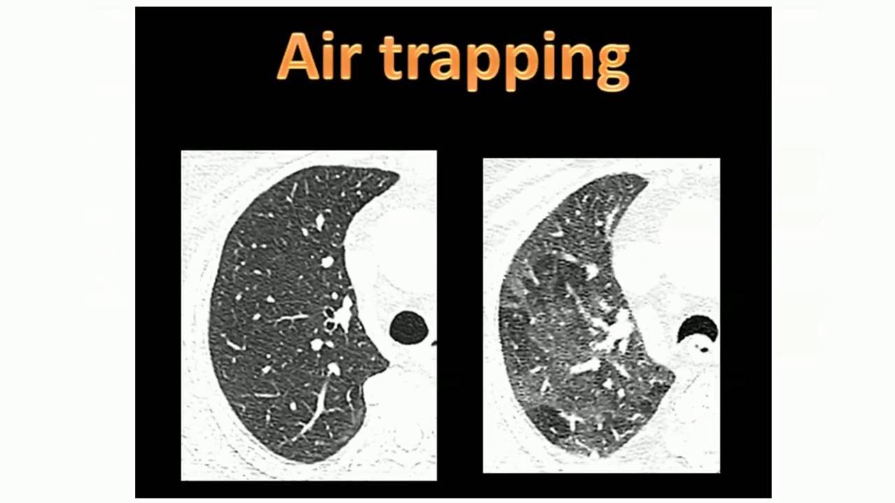 Aprisionamento aéreo na TC de tórax