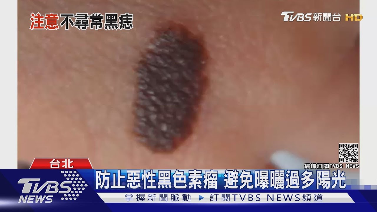 「這部位」長黑痣...確診惡性黑色素癌..醫師警告..別忽略它!｜十點不一樣 20210505