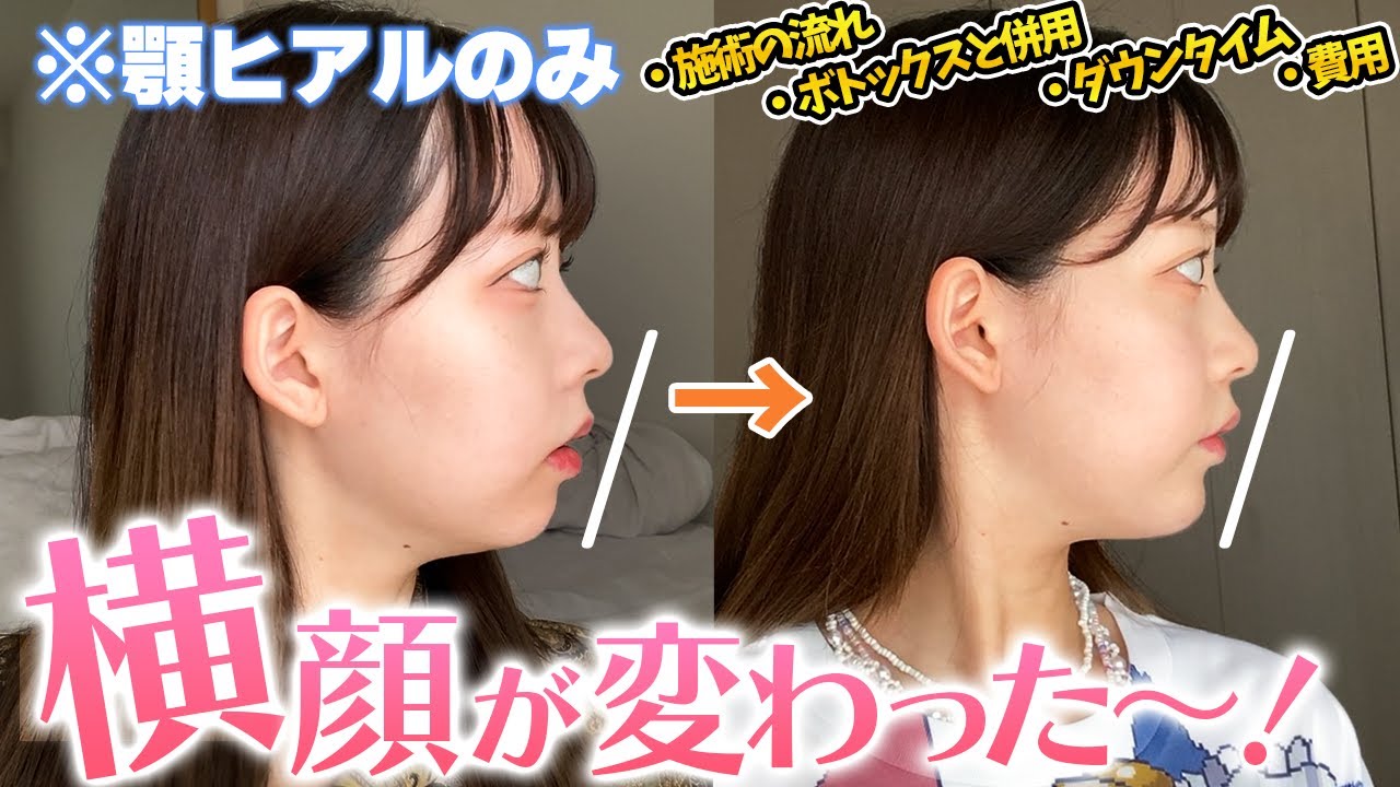 【顎ヒアル酸注入】整形してきたよ！体験レポ【ジュビタームビスタ】