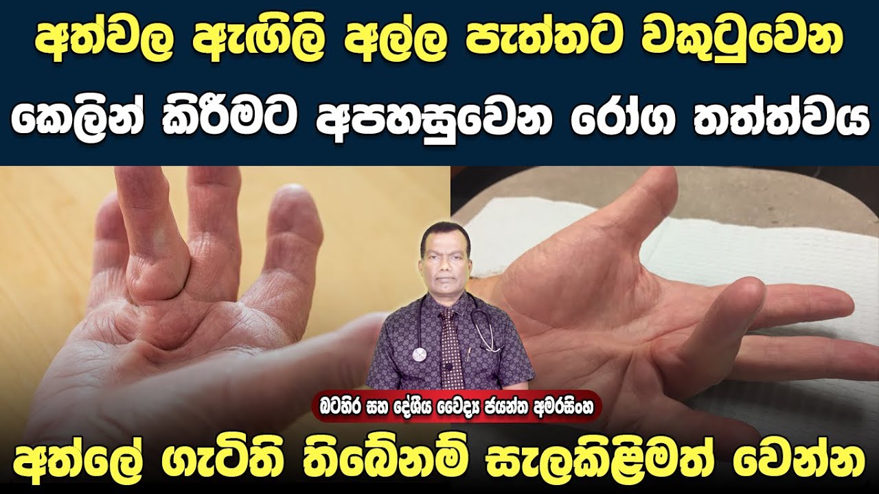 අත්වල ඇගිලි වකුටුවෙන කෙලින් කිරීමට අපහසුවෙන රෝගයක් වන Dupuytren's contracture