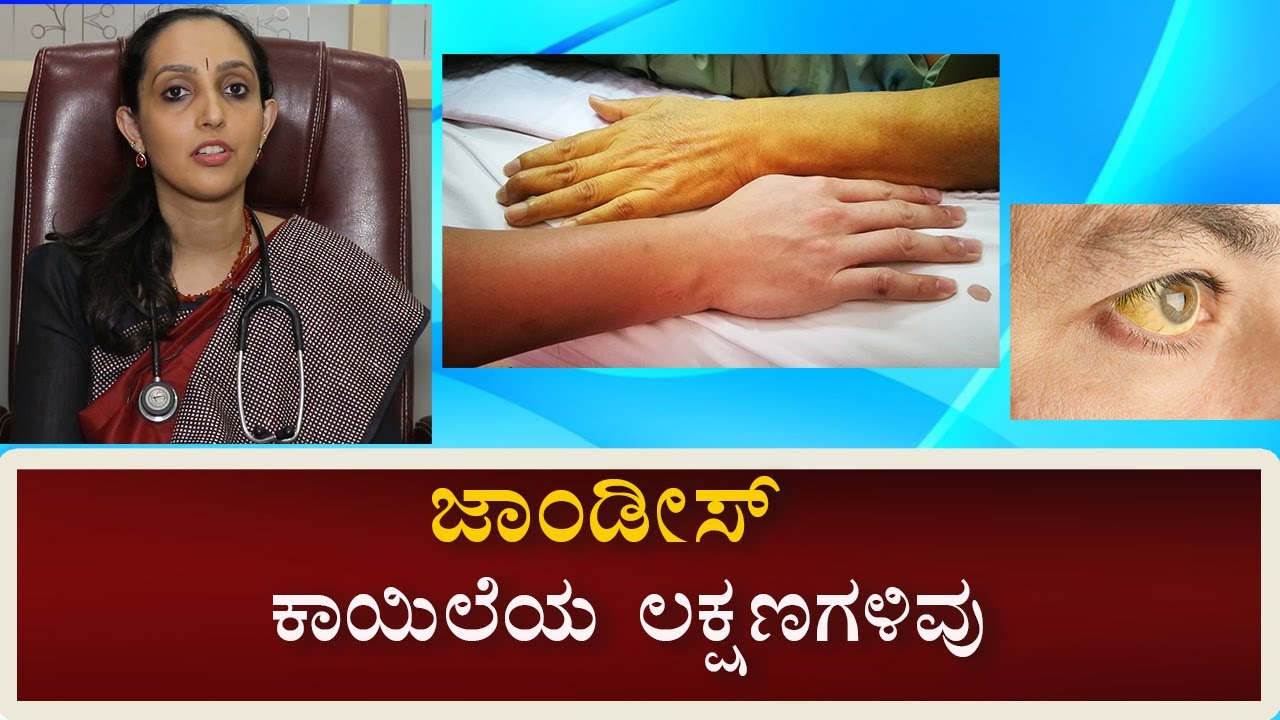 Jaundice: Symptoms and Causes | Vijay Karnataka