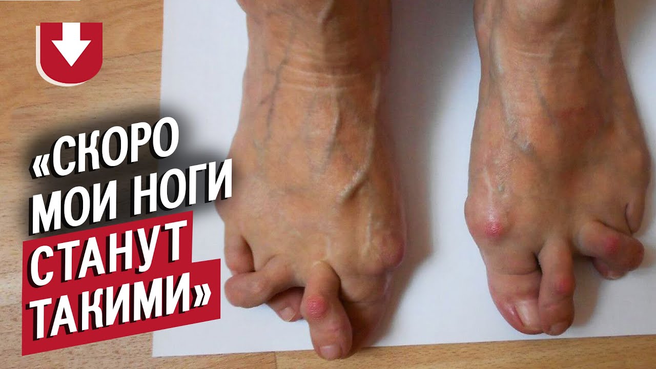 У меня ревматоидный артрит (очень жутко): Маша | Быть молодым