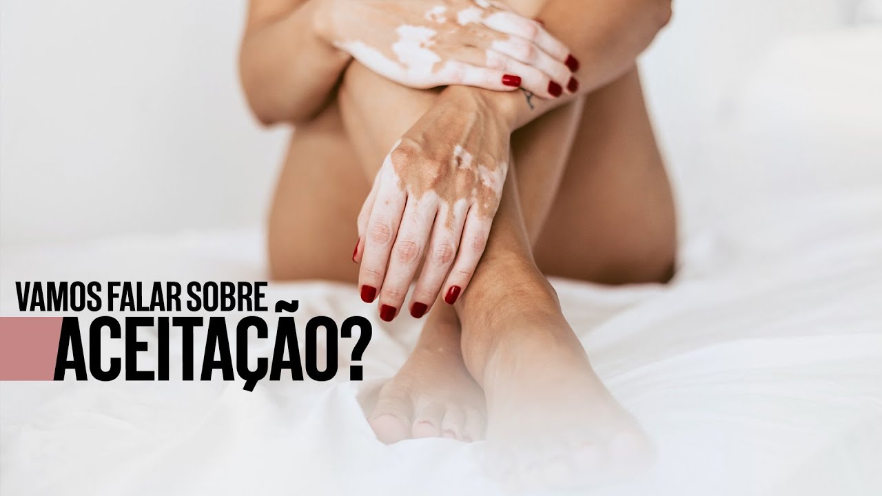 Vamos falar sobre aceitação do vitiligo?