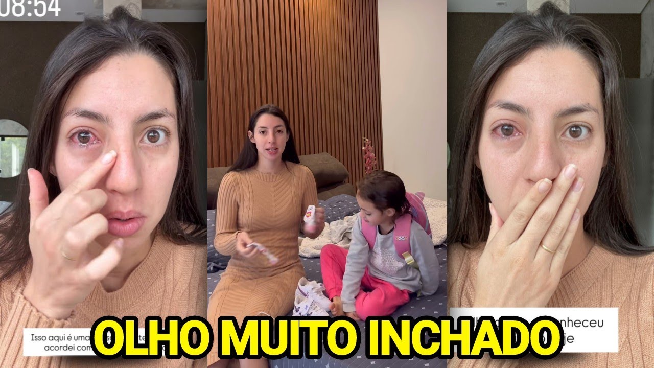 SARA KELLEN ACORDA COM OLHO INCHADO E DESABAFA+ ASSUSTOU OS SEGUIDORES