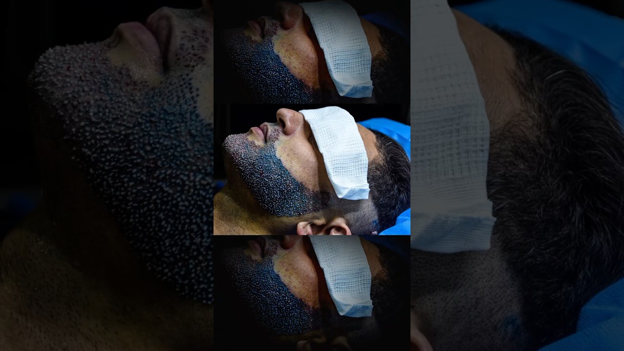 How does a beard transplant look after surgery? #vincihairclinic #shorts