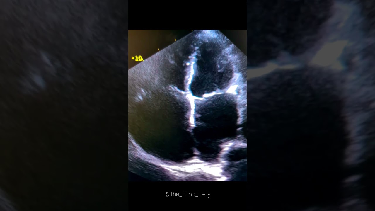 Big shunt! 😯 #cardiology #echocardiogram #echocardiography