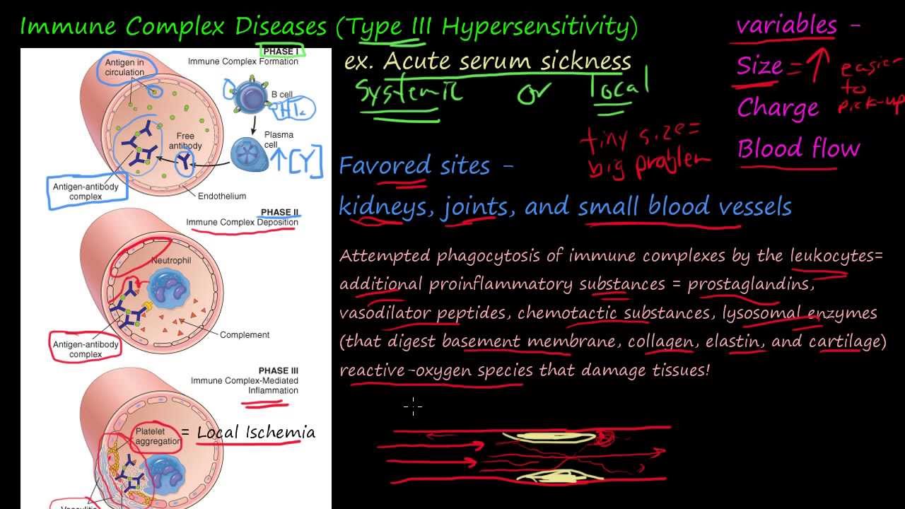 79P - Immune Complex Diseases, Type III Hypersensitivity