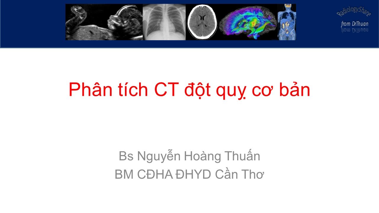 Phân tích CT đột quỵ cơ bản