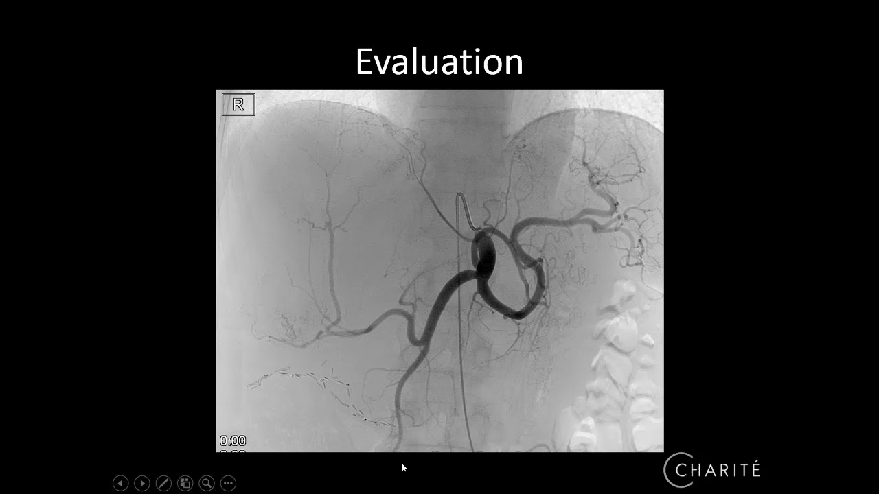 Transarterial radioembolization to treat primary or secondary liver cancer, D Schnappauf