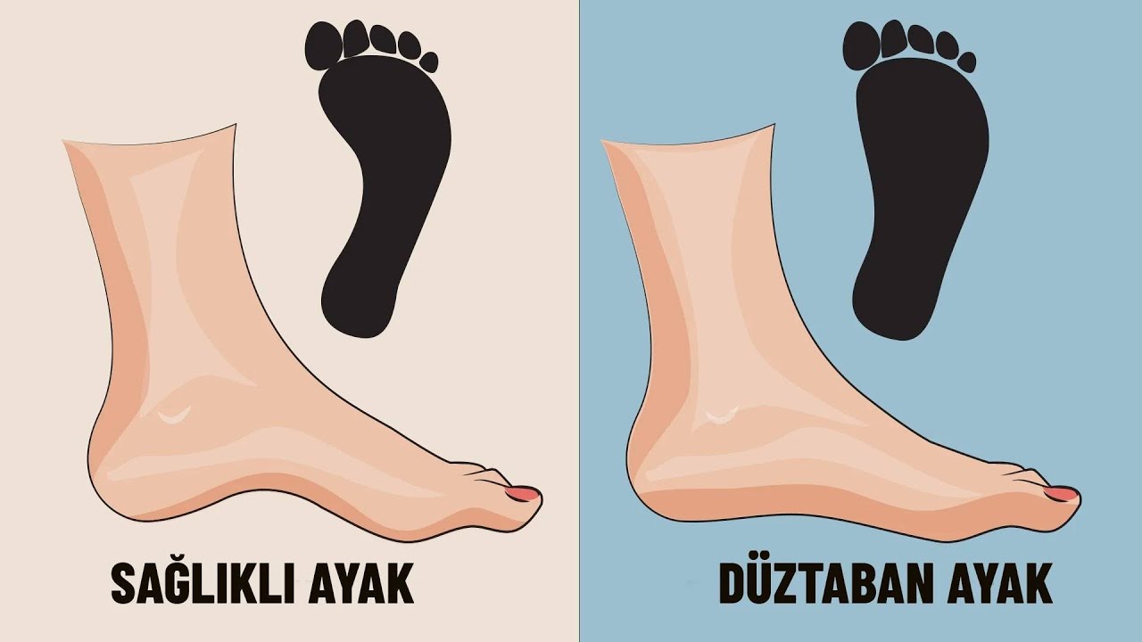 Düz tabanlık (Pes Planus) tedavi edilebilir mi? | Prof. Dr. Yakup YILDIRIM