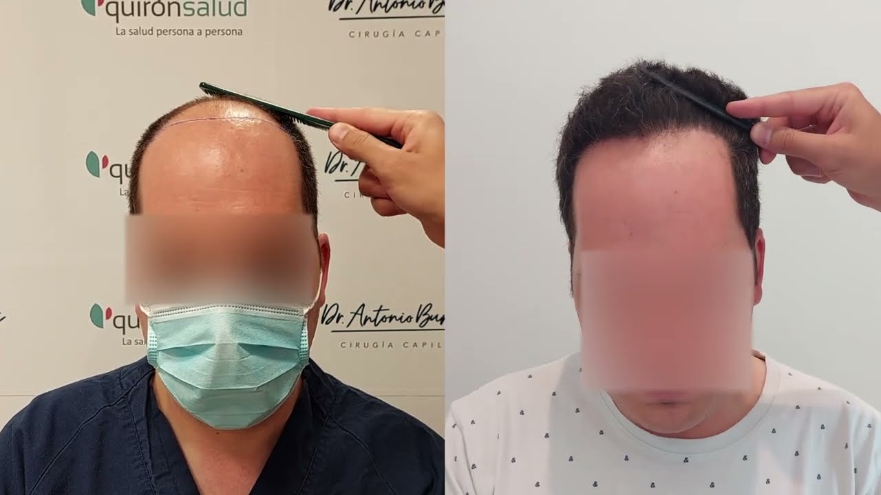 Injerto Capilar FUE - 3250 UFS - DR ANTONIO BURGOS