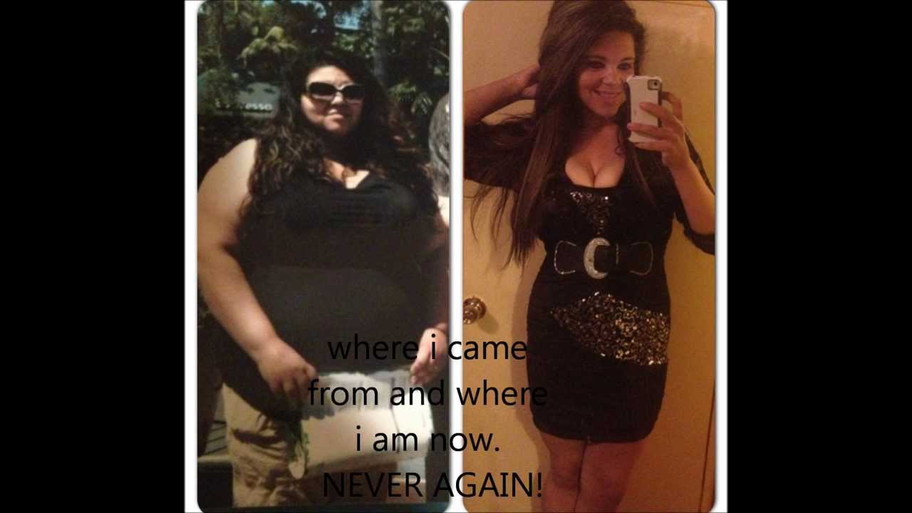 Gastric Bypass surgey before and after 1 year