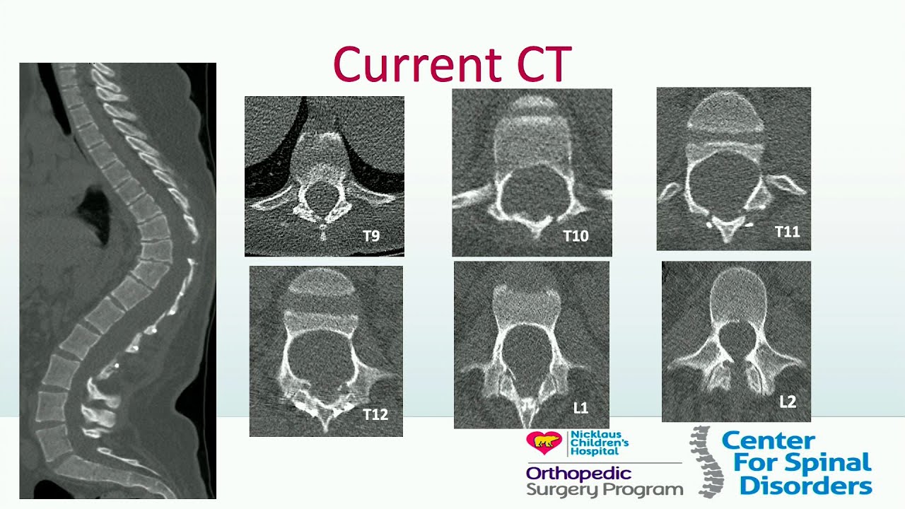 Operative Treatment of Early Onset Scoliosis - Stephen George, MD