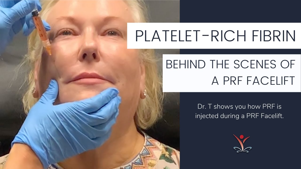 Watch a Behind the Scenes PRF Tear Trough, Cheeks & Nasolabial Fold Treatment
