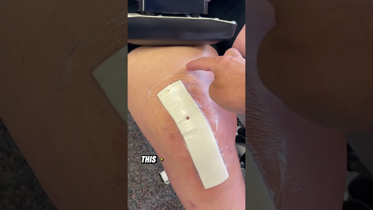 Day 2 of Physical Therapy After Total Knee Replacement - Dressing Assessment