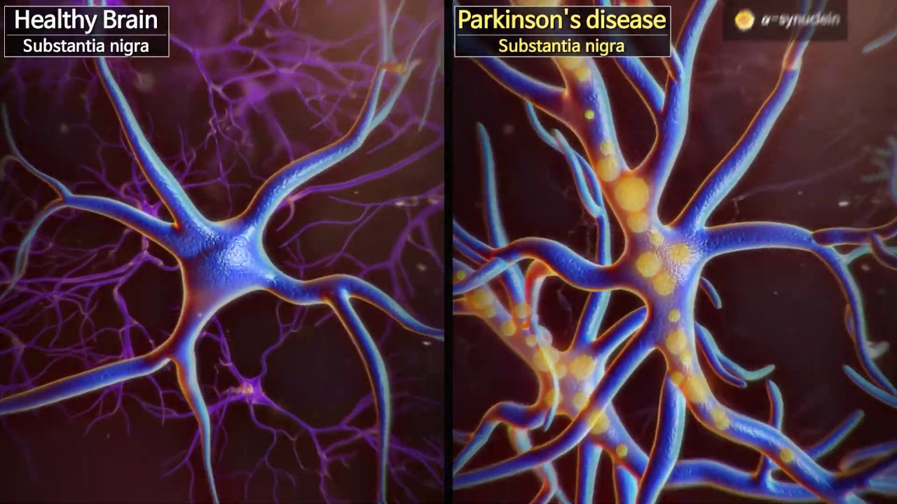 Wake up dormant dopaminergic neurons to reverse Parkinson’s disease
