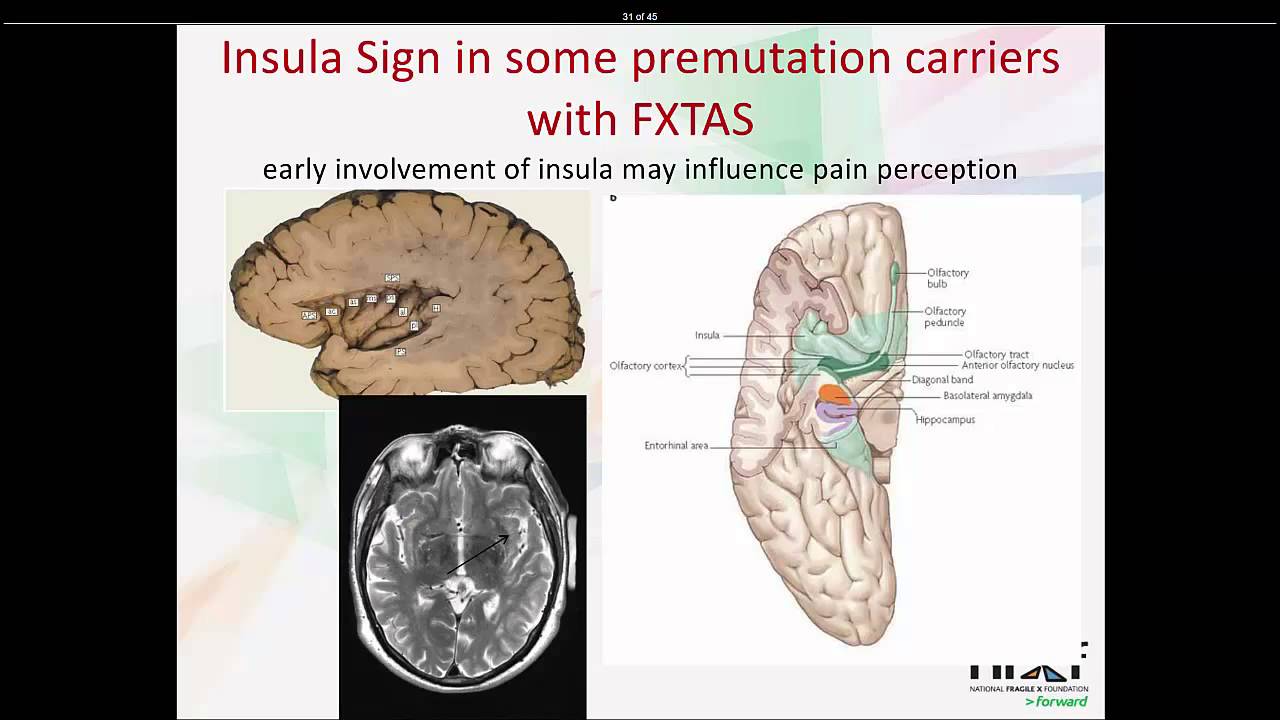 Let's Talk Fragile X Premutation Carriers and Health