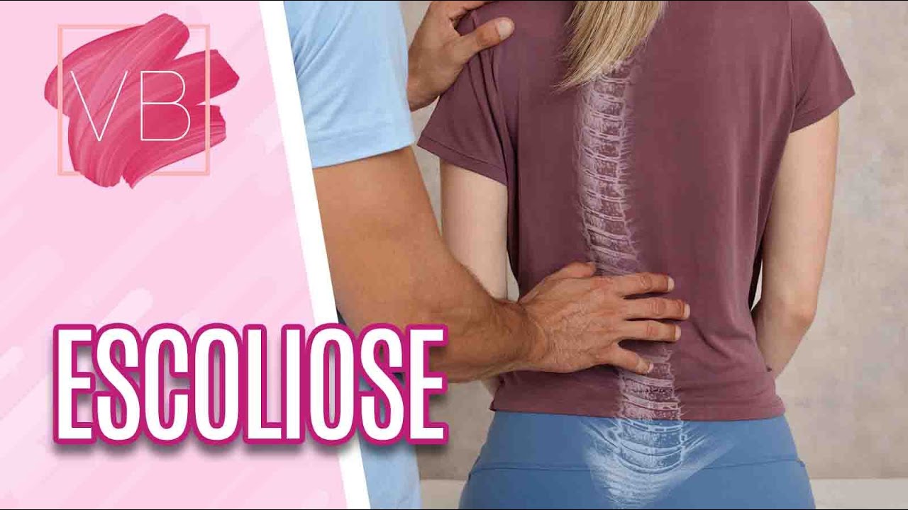 Entenda como se dá a escoliose - Você Bonita (09/06/21)
